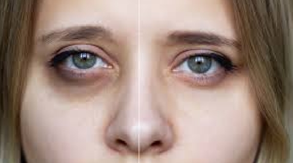 dark circles