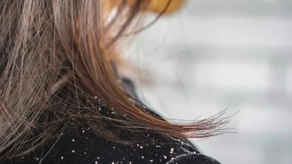 dandruff problems