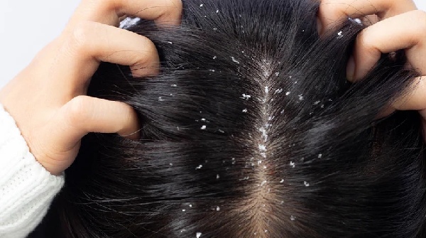 dandruff