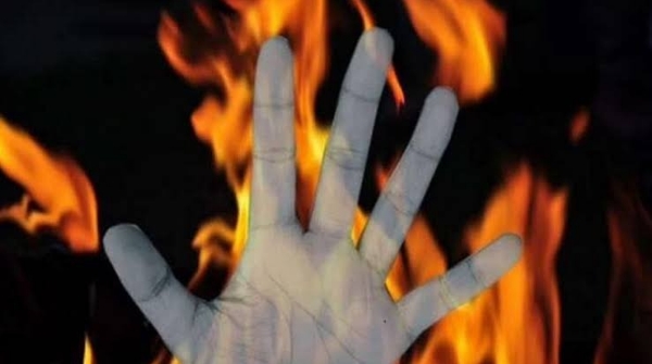 Minor girl burnt in Balanga Minor girl burnt in Balanga