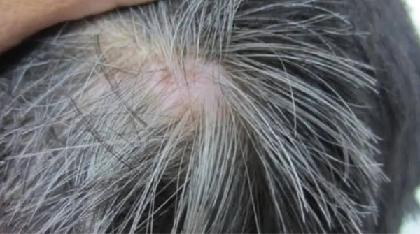 Why does hair turn white at a young age