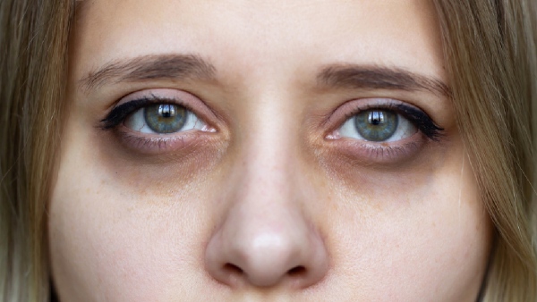 dark circles