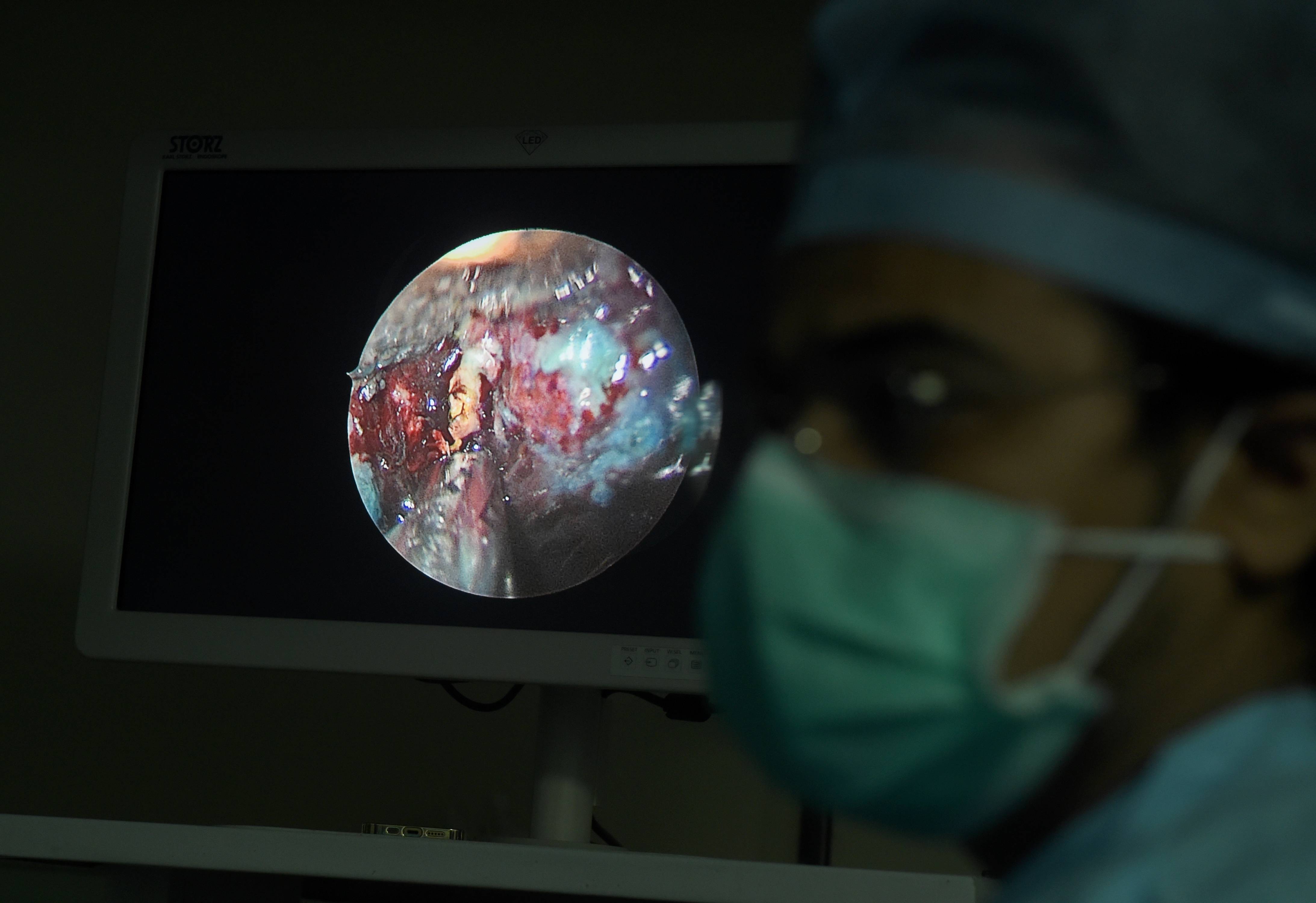 ബ്ലാക്ക് ആൻഡ് വൈറ്റ് ഫംഗസ് ബാധയേറ്റ രോഗിക്ക് നിർണായക ശസ്ത്രക്രിയ- ചിത്രങ്ങൾ