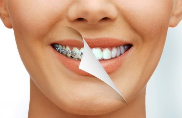 ആരോ​ഗ്യമുള്ള പല്ലുകളാണോ നിങ്ങൾക്ക് വേണ്ടത് എന്നാൽ തുടങ്ങാം ഈ  ശീലങ്ങൾ 