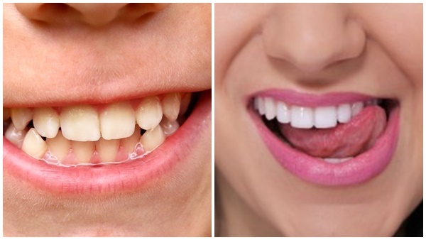 ആരോ​ഗ്യമുള്ള പല്ലുകളാണോ നിങ്ങൾക്ക് വേണ്ടത് എന്നാൽ തുടങ്ങാം ഈ  ശീലങ്ങൾ 