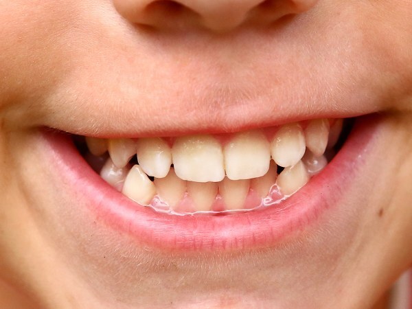 ആരോ​ഗ്യമുള്ള പല്ലുകളാണോ നിങ്ങൾക്ക് വേണ്ടത് എന്നാൽ തുടങ്ങാം ഈ  ശീലങ്ങൾ 