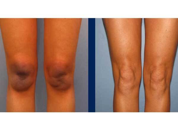 മുട്ടുകളിലേയും കക്ഷത്തിലേയും ഇരുണ്ട നിറം മാറുന്നില്ലേ: ഇതാ അടുക്കളയില്‍ തന്നെ പരിഹാര മാർഗ്ഗങ്ങളുണ്ട്