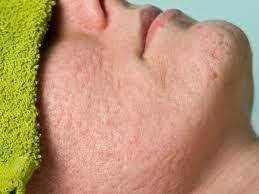 skin care: മുട്ടയുണ്ടോ.. മുഖത്തെ കുഴികൾ ദിവസങ്ങൾ കൊണ്ട് ഇല്ലാതാക്കാം