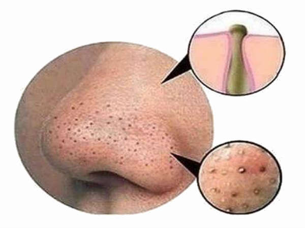 Face Care: ഇത്തിരി ഉപ്പുണ്ടോ മൂക്കിന്  ചുറ്റുമുള്ള  ബ്ലാക്ക് ഹെഡ്‌സിനെ ഇല്ലാതാക്കാം...