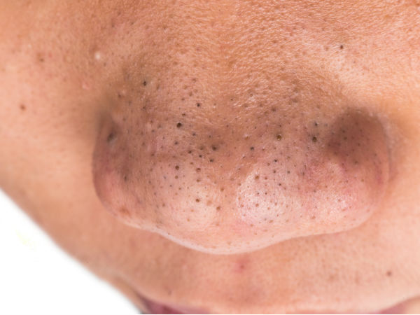  skin-ബ്ലാക്ക് ഹെഡ്സാണോ വില്ലൻ? സിമ്പിളായി തന്നെ നീക്കാം, അറിയാം മാർഗങ്ങൾ 