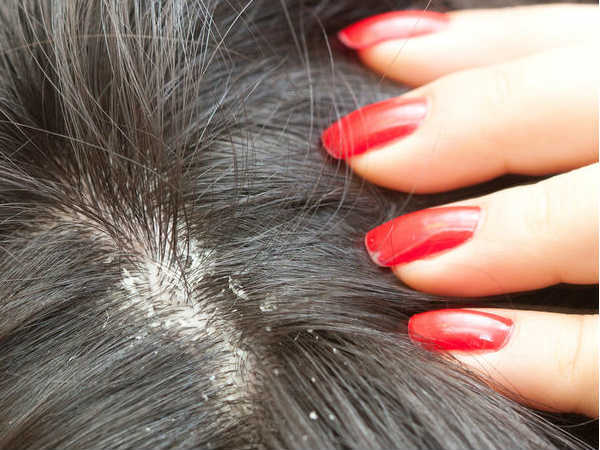 Hair Care:താരന്‍ പോകാന്‍ ഏത് ഷാംപൂ ഉപയോഗിക്കണം?എത്ര തവണ?