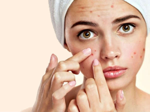 Skin: മുഖക്കുരു വല്ലാത്ത പ്രശ്‌നമാണോ? ഇതൊന്ന് പുരട്ടി നോക്കൂ; ചര്‍മം സുന്ദരമാകും