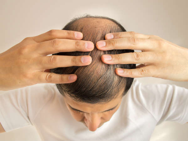 Hair loss: മുടി കൊഴിയുന്നോ; ചികിത്സയ്ക്ക് മുമ്പ് ഇക്കാര്യങ്ങള്‍ ഉറപ്പായും ശ്രദ്ധിക്കണം, ഇല്ലെങ്കില്‍ പണി കിട്ടും