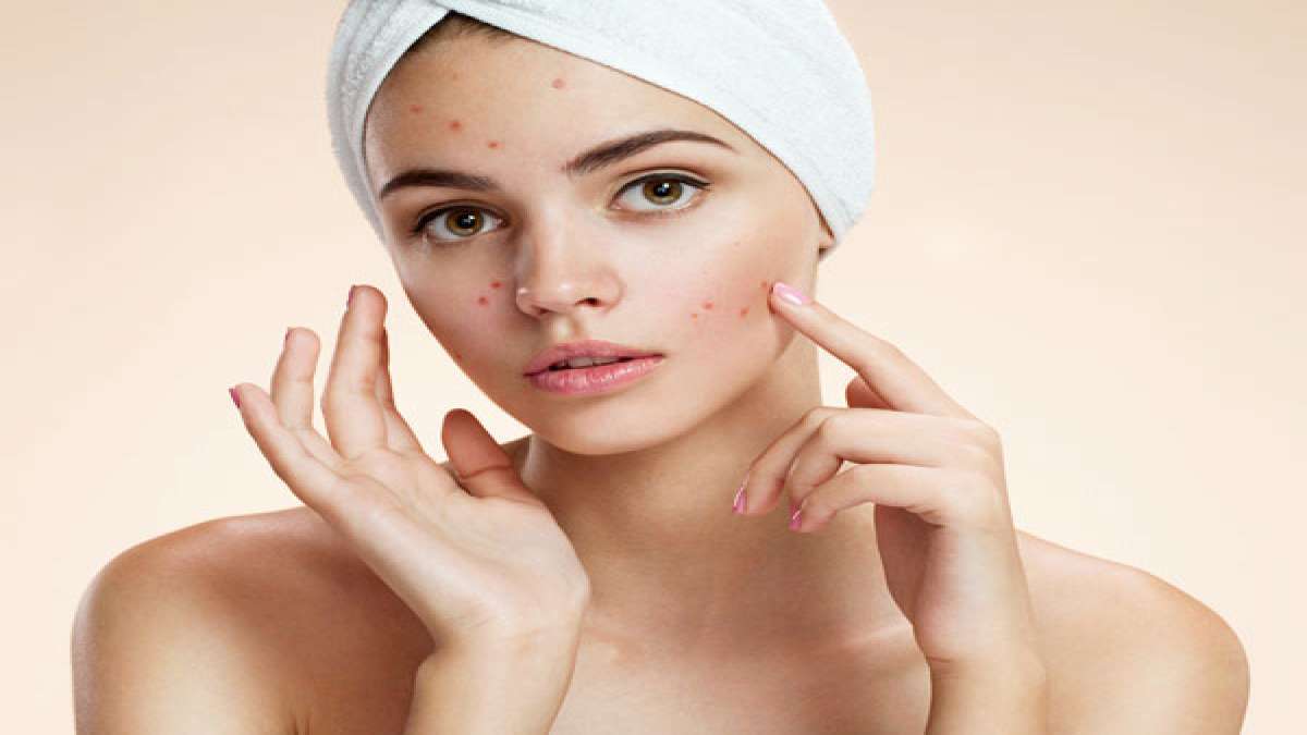 Face care: മുഖക്കുരു പമ്പ കടക്കണോ, ഇതാ ഏതാനും പൊടിക്കൈകള്‍