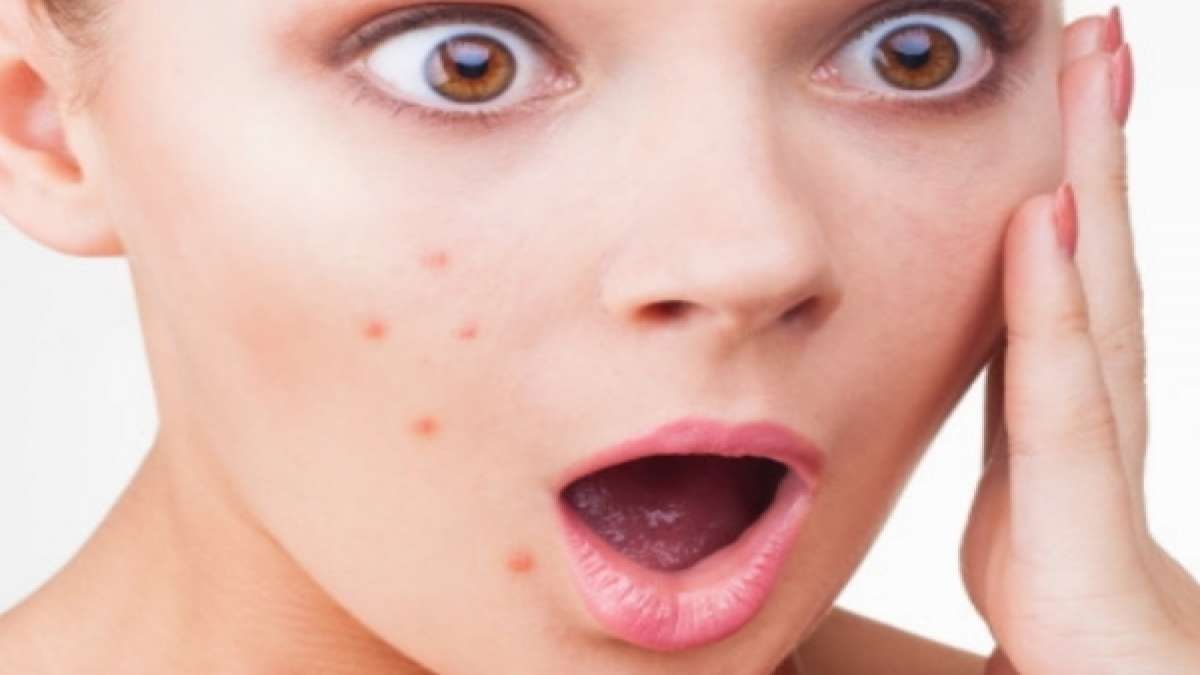 Face care: മുഖക്കുരു പമ്പ കടക്കണോ, ഇതാ ഏതാനും പൊടിക്കൈകള്‍