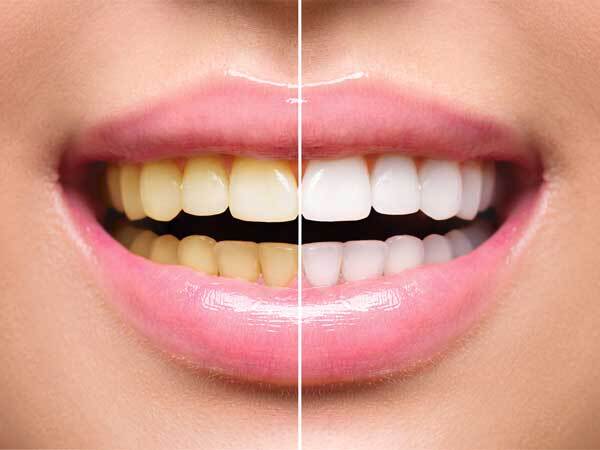 Teeth whitener-പല്ലിന്റെ മഞ്ഞ നിറം മാറ്റാം; വെളുപ്പിക്കാന്‍ ഇതാ വഴികൾ