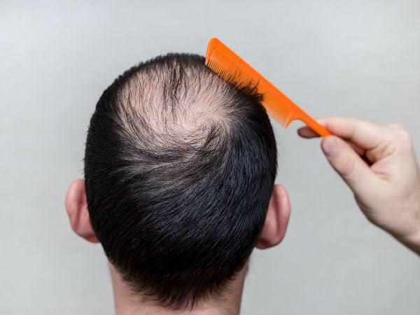 Hair care: പ്രമേഹം മുടിക്കും വില്ലന്‍: മുടികൊഴിച്ചില്‍ വർധിക്കും, പക്ഷെ പരിഹാരമുണ്ട്