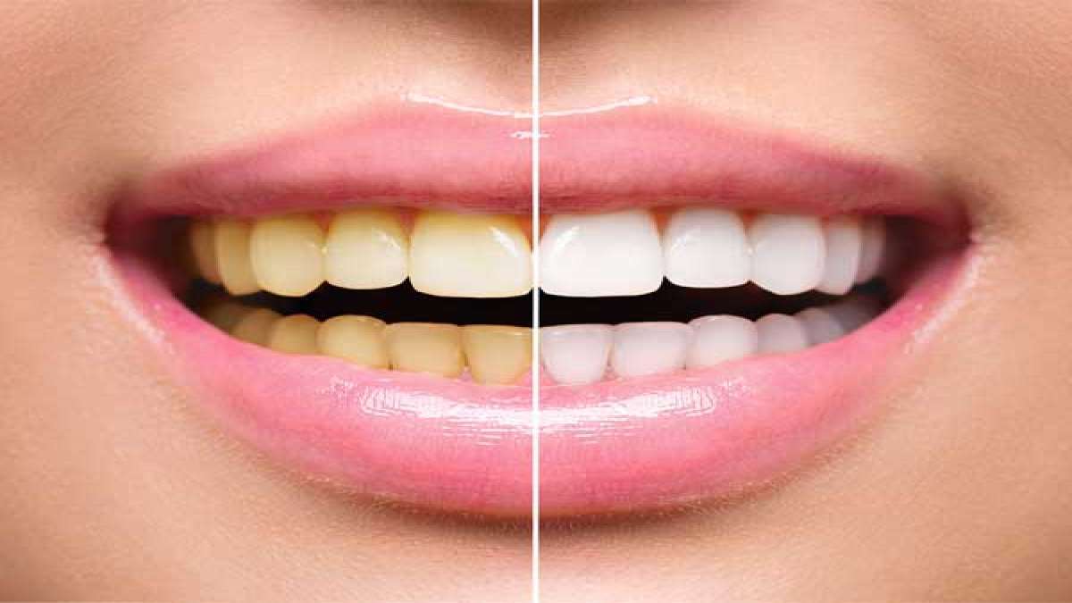 Teeth Care Tips: പല്ല് സംരക്ഷണം പേരിന് പോര, ശ്രദ്ധിക്കണം ഈ കാര്യങ്ങള്‍