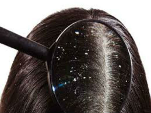 Hair Care: തിളങ്ങും, തിങ്ങിത്തിങ്ങി വളരും.. ചെയ്യേണ്ടത് ഇക്കാര്യം