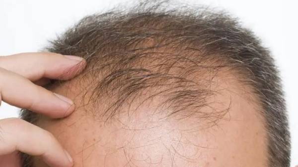 Hair Growth:  ഈ നാല് എണ്ണകൾ നിങ്ങളുടെ തലയിൽ മായാജാലം തീർക്കും.. കഷണ്ടിയിലും മുടി വരും