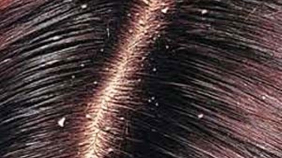 Hair Care: പൊടിക്കൈകൾ മാത്രം പോര, ചില കാര്യങ്ങൾ തീർച്ചയായും ശ്രദ്ധിക്കണം; താരന് ബൈ പറയാം