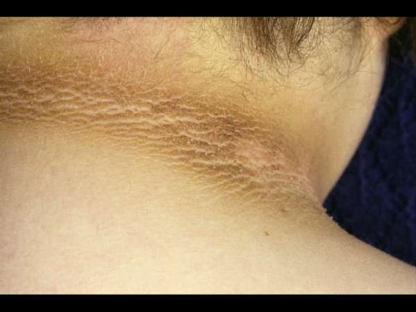 Skin Care: കഴുത്തിന്  ചുറ്റും കറുപ്പ് നിറമാണോ?  ആദ്യം കാരണം അറിയാം, പിന്നെ പരിഹാരം 