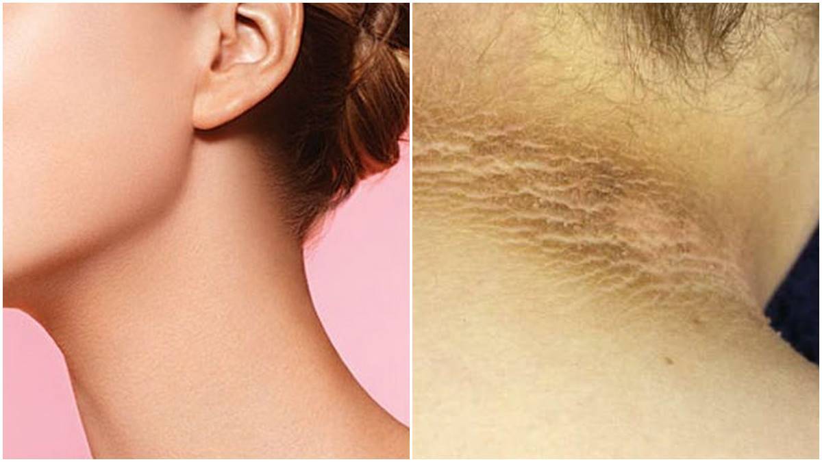 Skin Care: കഴുത്തിന്  ചുറ്റും കറുപ്പ് നിറമാണോ?  ആദ്യം കാരണം അറിയാം, പിന്നെ പരിഹാരം 