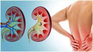 Kidney problems