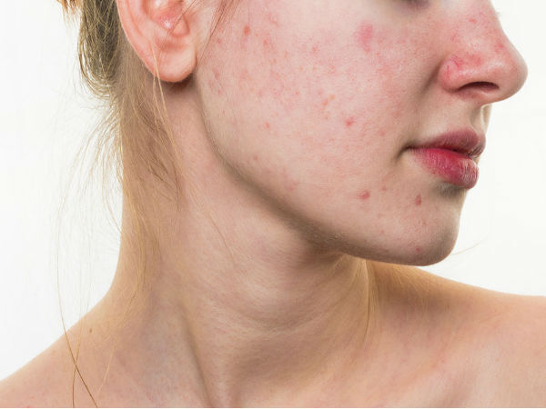 Acne