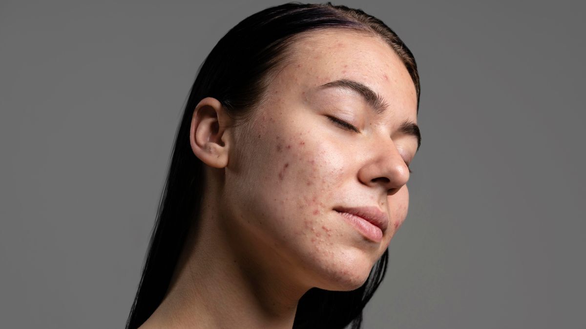 Acne