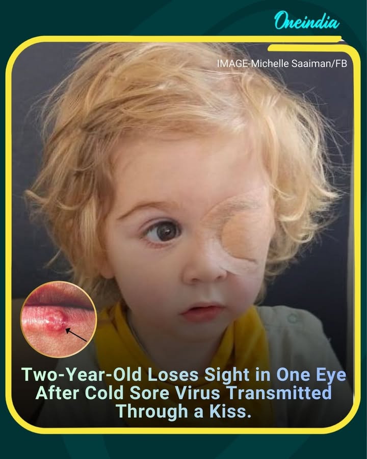 Two-year-old Juwan lost vision in his left eye after the herpes simplex virus, commonly responsible for cold sores, was transmitted to his eye through a kiss. The rare but serious incident highlights how the virus can cause severe complications in young children when it spreads beyond the mouth area.