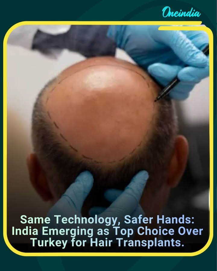 India is rapidly gaining recognition as a preferred destination for hair transplant procedures, offering the same advanced technology as Turkey but with safer practices, experienced surgeons, and cost-effective solutions. Patients are increasingly choosing India for quality results, comfort, and reliable aftercare.