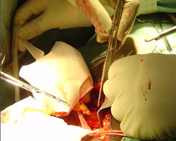kidney transplant operation