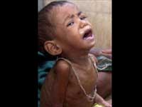 Malnourished Child Malnourished Child