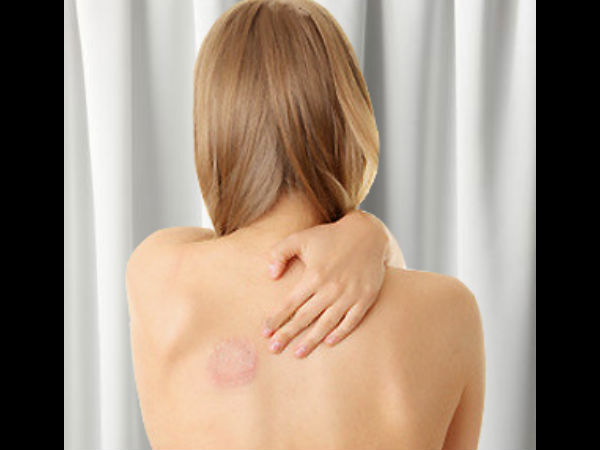 பூஞ்சை தொற்றுநோய் ஜாக்கிரதை