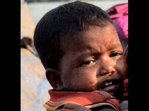 பீகாரில் ஊட்டச்சத்து குறைபாடு மோசம்