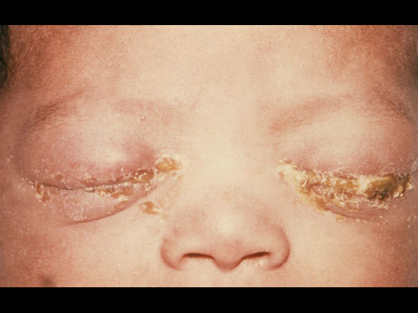 ஆண்களுக்கு அறிகுறிகள்