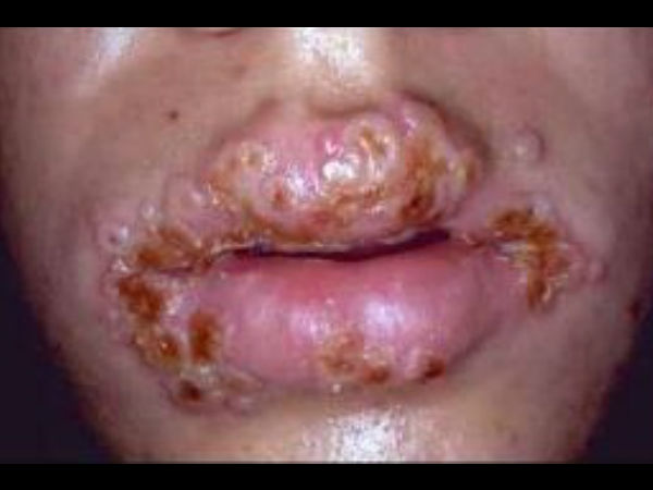 மருந்து தேவை