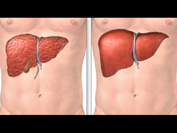 கல்லீரல் அறுவை சிகிச்சை