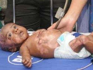 Burning child Rahul discharged from Kilpauk hospital Burning child Rahul discharged from Kilpauk hospital