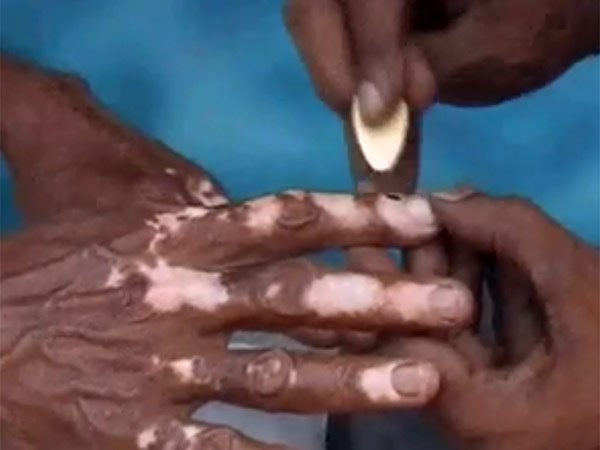 வெண்குஷ்டம்