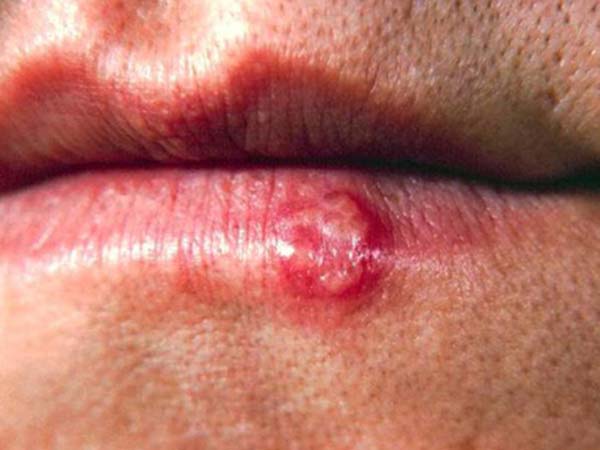 ஹெர்பஸ்