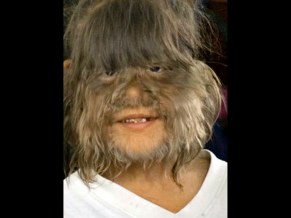 ஹைபர்டிரிசோசிஸ்... ஹைபர்டிரிசோசிஸ்...