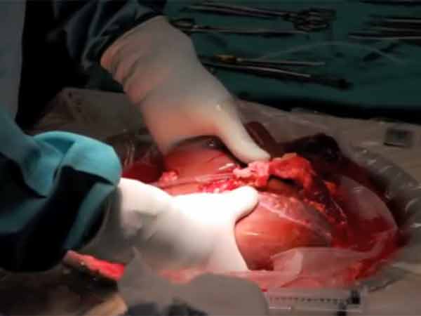 வேலூருக்கு சென்ற கல்லீரல்...