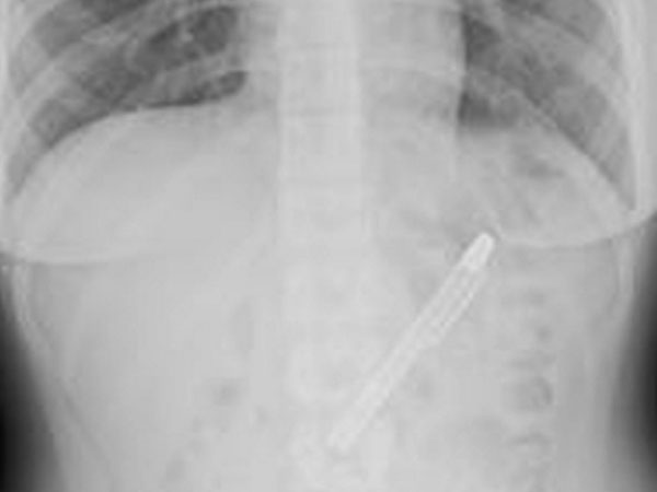 Fountain pen removed from girl’s stomach after being stuck there for six months Fountain pen removed from girl’s stomach after being stuck there for six months