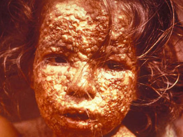 வைரஸ் குப்பிகள்: