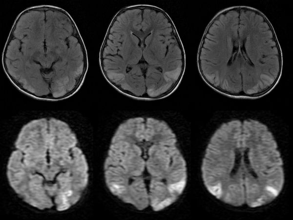 பீகாரில் நோய் தாக்குதல் 