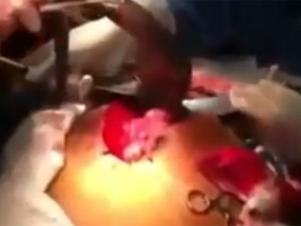 உயிரோடு வெளியேற்றப்பட்ட மீன்: