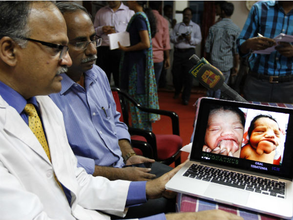50 gram mouth tumour removed