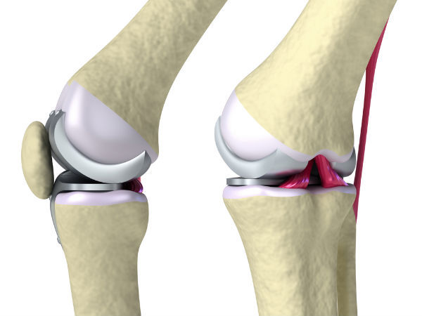 எலும்புருக்கி நோய்: